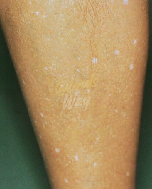 The Shocking Truth Behind Those Tiny White Spots on Your Skin 1