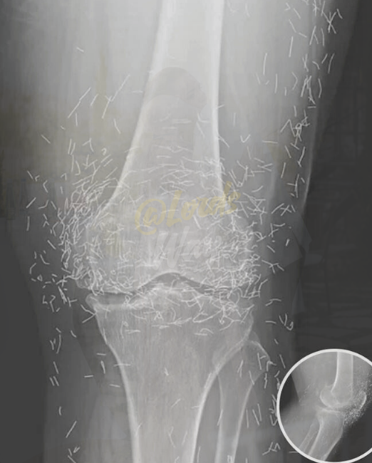 Doctors Were Shocked When They Saw What Was Inside Her Knee 12