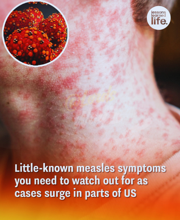 Doctors Are Warning About the Return of a Disease Many Thought Was Gone 11