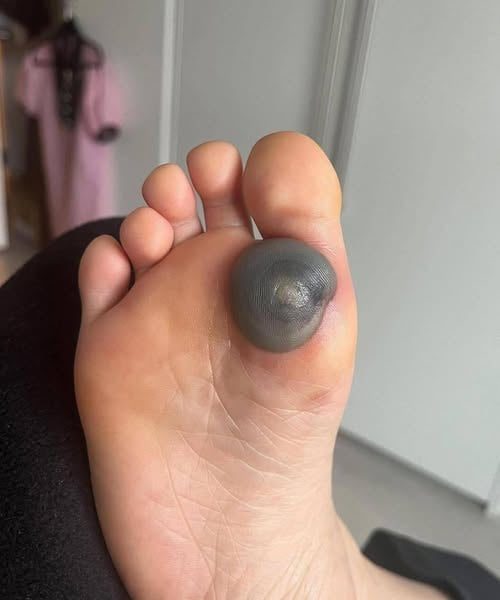 That Dark Blood Blister Might Look Scary—But Here’s the Truth 12