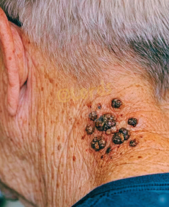 The Dark Neck Spots Many Older Adults Get (And What They Really Mean) 5