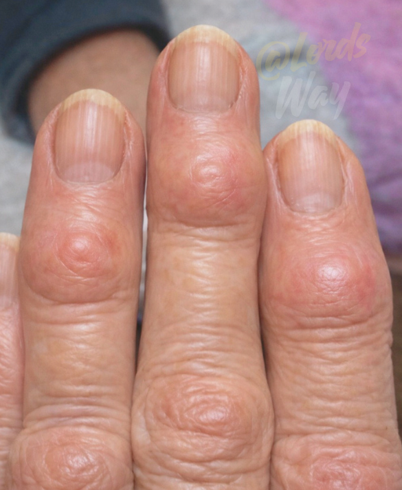 Those Small Finger Bumps? They Might Be Telling You More Than You Think 9